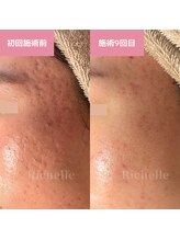 リシェル(Richelle)/ 【GREENPEEL5days】