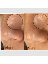 毛穴専科/グレースピール！那覇/沖縄