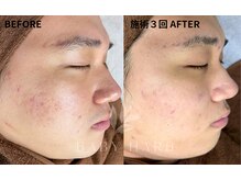 フィズ 経堂店(FIS)/☆ハーブピーリングで美肌に☆