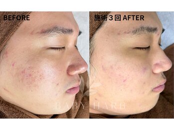 フィズ 経堂店(FIS)/☆ハーブピーリングで美肌に☆