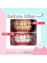 エクシアホワイトニング 札幌中島公園店/BeforeAfter［ホワイトニング］ 