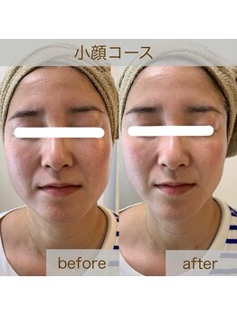 トータルビューティーサロン ティティ(Titi)/たるみ改善!1回で憧れの小顔へ