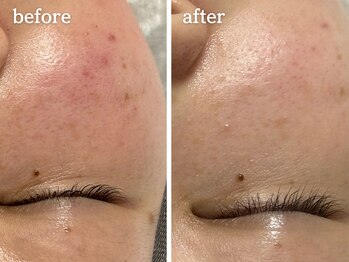 メルシア(merucia)/跡、ニキビケア、赤み改善