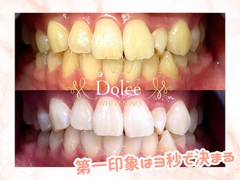 ドルチェ(Dolce)/ビフォーアフター