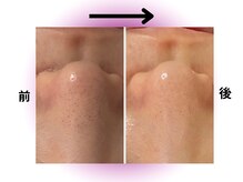 カリアンヌ/毛穴洗浄毛穴黒ずみフェイシャル