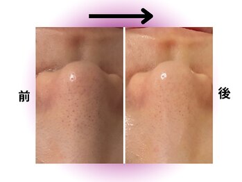 カリアンヌ/毛穴洗浄毛穴黒ずみフェイシャル