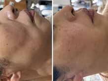 頬のたるみもこのとおり！サロンでヒト幹100%のトリプルショット