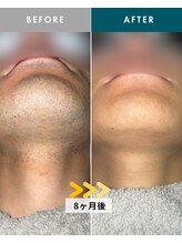 モモナ(Momona)/佐世保/脱毛/髭脱毛/全身脱毛