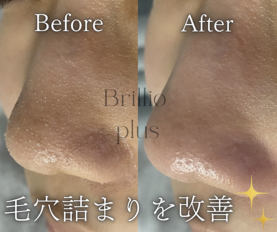 水玉リフティング 京都に関するエステサロン Brillio plus 四条烏丸店