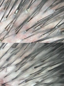 ミラー(MIRROR)の写真/マイクロスコープで毛髪診断！大人の頭皮エステで、髪悩みに◎