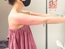 フローフシ∞/【二の腕】1ヶ月施術後