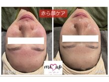 ミーアップ(Me up)/赤ら顔・赤みケアも得意です！