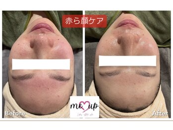 ミーアップ(Me up)/赤ら顔・赤みケアも得意です!