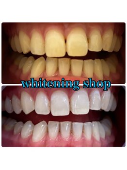 ホワイトニングショップ 豊橋店(WHITENING SHOP)/Before&After豊橋ホワイトニング