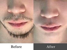 メンズオージー 岡山中区(men's O.G)/メンズ脱毛｜ひげ脱毛