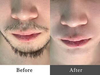 メンズオージー 岡山中区(men's O.G)/メンズ脱毛｜ひげ脱毛