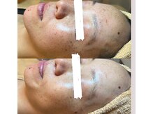 低周波だけでなく独自の施術で肌底のシミの元　にアプローチ♪