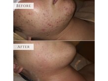 ラシェプリズ(LACHER PRISE)/ニキビケア・改善例