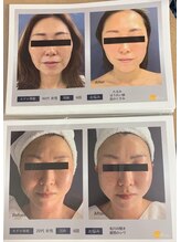 エステティック レイビス 銀座店(RAYVIS)/before＆after