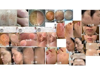 シェリー(Cherie)/施術なし！長年悩むニキビケア