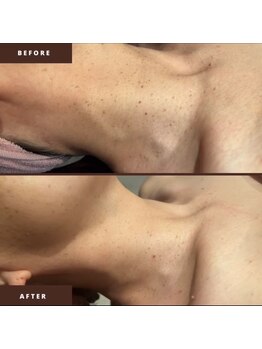 インフィニティ ビューティサロン 姫路店(INFINITY beautysalon)/-シミケア-お顔・首・体