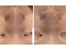 ペルナ(perna)/ハーブピーリング＋毛穴洗浄