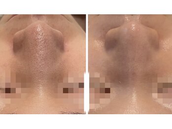 ペルナ(perna)/ハーブピーリング＋毛穴洗浄