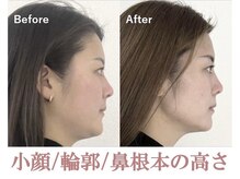 隆鼻矯正専門店 ラプリ(Raplit)/隆鼻＋輪郭矯正40分10回