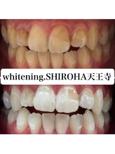 シロハ(SHIROHA)/セルフホワイトニング/天王寺