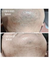 ビメンズ(BiMen's)/ヒゲ脱毛before/after☆