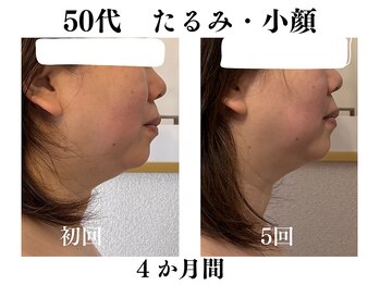ランティル(l’until)の写真/ダイエットでも落ちない顔の脂肪。輪郭からはみ出る脂肪。二重アゴの脂肪を分解。たるみもスッキリ解決！