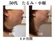ランティル(l’until)の写真/ダイエットでも落ちない顔の脂肪。輪郭からはみ出る脂肪。二重アゴの脂肪を分解。たるみもスッキリ解決！
