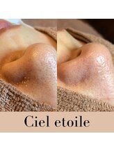 シエルエトワレ/毛穴エクストラクション