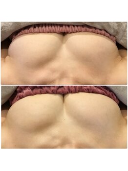 サチ(Sachi)/年々下垂してブラが合わない