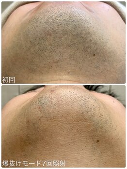 ヒスイ バイ アメイジング(Hisui by AMAZING)/【光脱毛】男性髭 &nbsp;IPL &nbsp;&nbsp;爆抜け