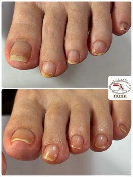 ネイルカフェ ナナ(nailcafe'nana)/フットトラブルケア