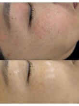 チョアビューティー(choa beauty)/しみ・トーンケアで明るい肌へ