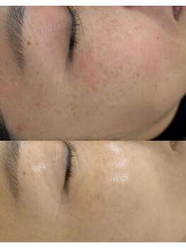 チョアビューティー(choa beauty)/しみ・トーンケアで明るい肌へ