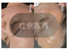 クラスペディア 嘉島店/ララピール/毛穴洗浄症例写真