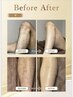 【選べる6か所】最新光脱毛☆頑固な毛にも効果◎ ￥7,500