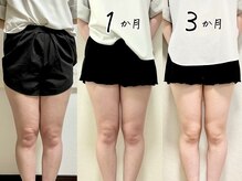 脂肪冷却×筋肉増強３ヶ月！ただ寝にきてるだけでびっくり！