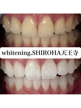 シロハ(SHIROHA)/セルフホワイトニング/天王寺