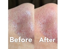 ルルシェリー 白河店の雰囲気（洗顔では取れない、角栓をごっそり取り除きます♪白河毛穴洗浄）