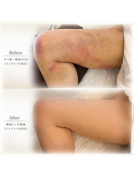 マドモアゼルメゾン 恵比寿(マドモアゼルMaison)の写真/【太もも術後ケア】脚の腫れ・むくみ・拘/縮を集中ケア◎すっきり美脚ラインへ♪