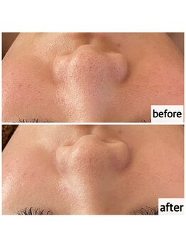 メナードフェイシャルサロン 岐阜茜部/ホワイトニングパック