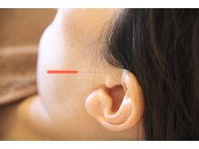 オリエントエクスプレス/耳の症状にも鍼灸が◎