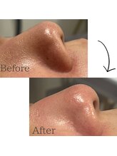 アットウィル 志木店(at will)/毛穴洗浄BeforeAfter