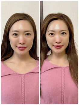 メディカルエース(MedicalAce)/【最強引き上げ】ハイサーマ