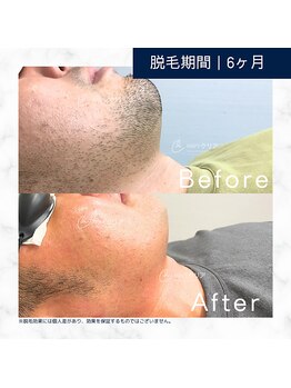 メンズクリア 小山店/【メンズクリア】お客様の施術例