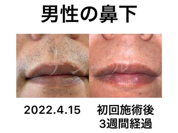 デジール/【メンズ脱毛】